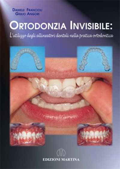 ORTODONZIA INVISIBILE: L’utilizzo degli allineatori dentali nella pratica ortodontica